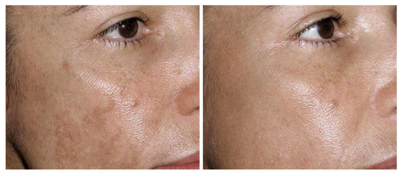 Удаление пигментации лазером на лице до и после фото